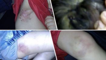 وحوش.. رجل يعذب ابنة زوجته الطفلة ويكويها بالنار فى أماكن حساسة والأم تتستر