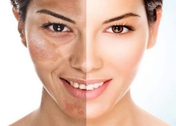 الكلف أليك أهم 9 أسباب رئيسية وراء ظهوره وكيفية علاجه