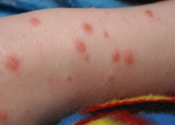 الأردن.. الصحة تكشف مواقع أعلى الإصابات بمرض الجدري