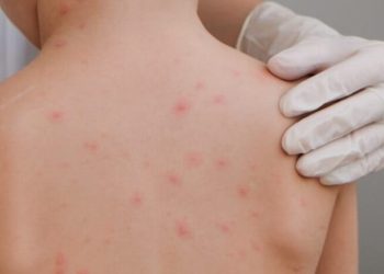 مكافحة الأوبئة .. وزارة الصحة بصدد إدخال مطعوم للجدري