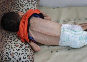 الجوع يفتك بأطفال غزة .. ارتفاع وفيات الجوع في غزة إلى 86 بينهم 23 خلال 48 ساعة