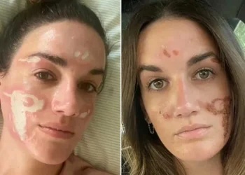 خبيرة تجميل شهيرة تشوه وجه فتاة أثناء علاج حب الشباب