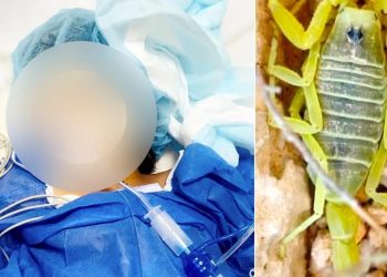طفلة بحالة حرجة بعد لدغة من أخطر أنواع العقارب
