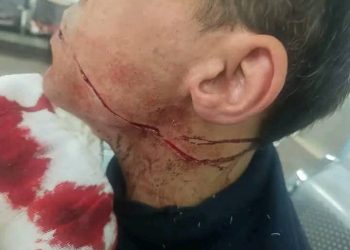 22 غرزة في وجه فتى من ذوي الإعاقة يعمل في صالون حلاقة في عمان