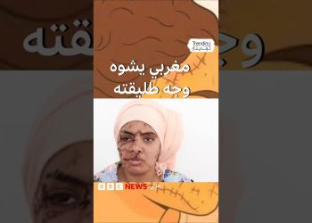 رجل يشوه وجه طليقته .. قصة إيمان تهز الشارع المغربي