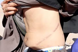 أردني يبيع كليته لسفير عربي ويحاول بيع كلية زوجته