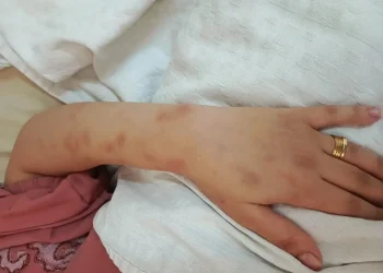 وفاة أردنية.. زوجها حجزها يومين بالحمام وحرق جسدها بالسجائر والفحم