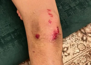 4 كلاب ضالة تهاجم طفلاً في البادية الشمالية