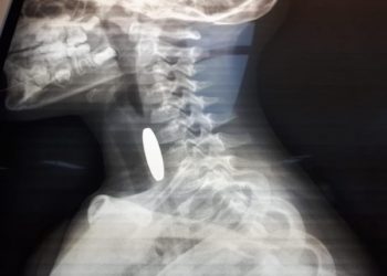 إنقاذ طفل تعرض لاختناق إثر ابتلاع عملة معدنية